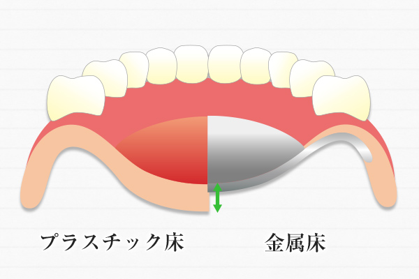 入れ歯による治療