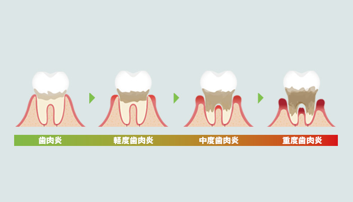 歯周病の治療