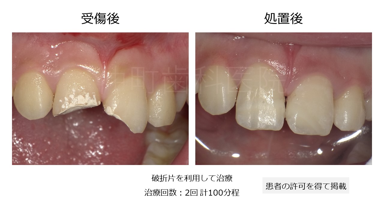 欠けた歯を破片で修復した術後の写真