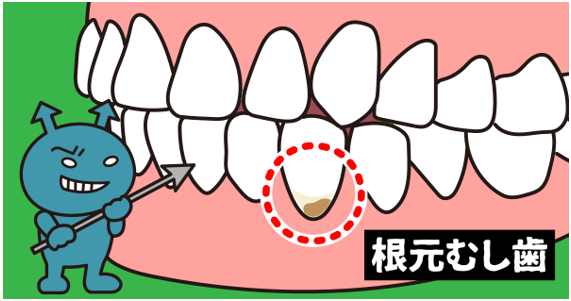 歯ぐきが下がったら要注意!大人に多い根元むし歯