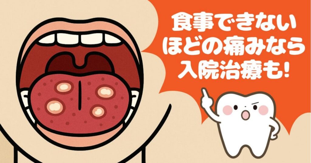 ◆ヘルペス性口内炎
