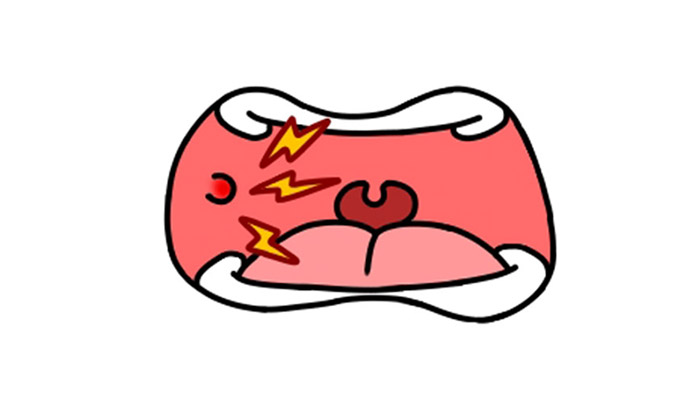 みんな一度はなっている「口内炎」について