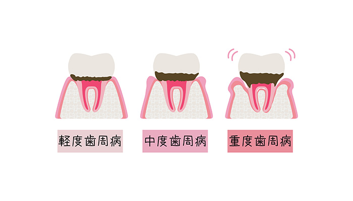 歯周病の恐ろしさ