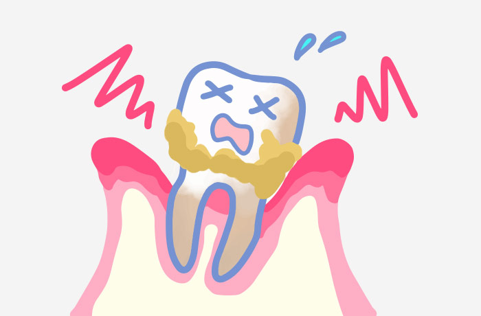 歯がうずく原因