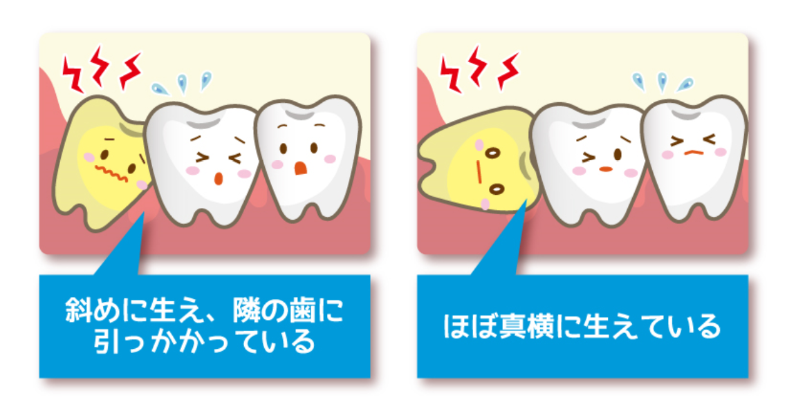 親知らず02