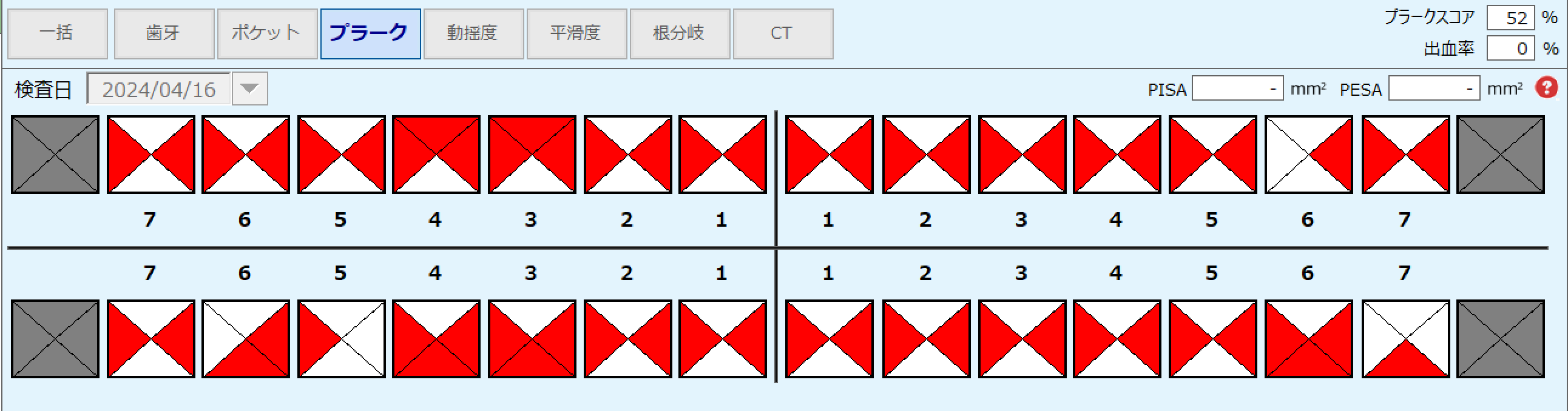 PCR表（1つの歯を4ブロックに分けて磨き残しを記録した表）