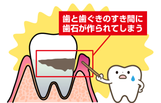 🦷歯石を放置すると歯周病が悪化する！
