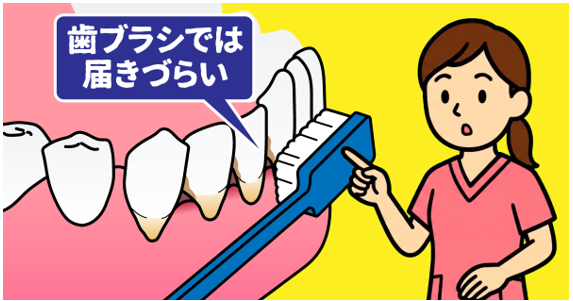 歯ぐきが下がったら要注意!大人に多い根元むし歯