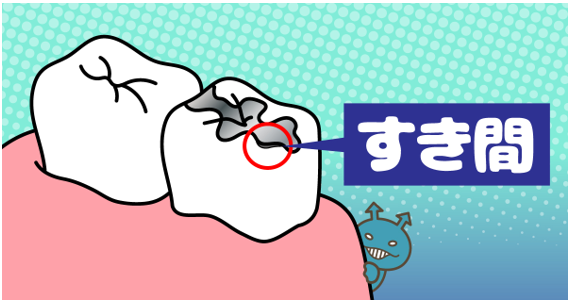 つめもの・かぶせものが外れる！ その寿命と原因は？
