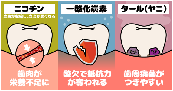 その1本が歯の寿命を縮める!?喫煙と歯周病の関係