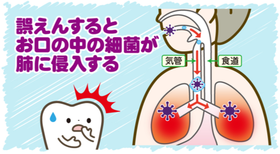 命に係わる!?誤えん性肺炎の恐怖