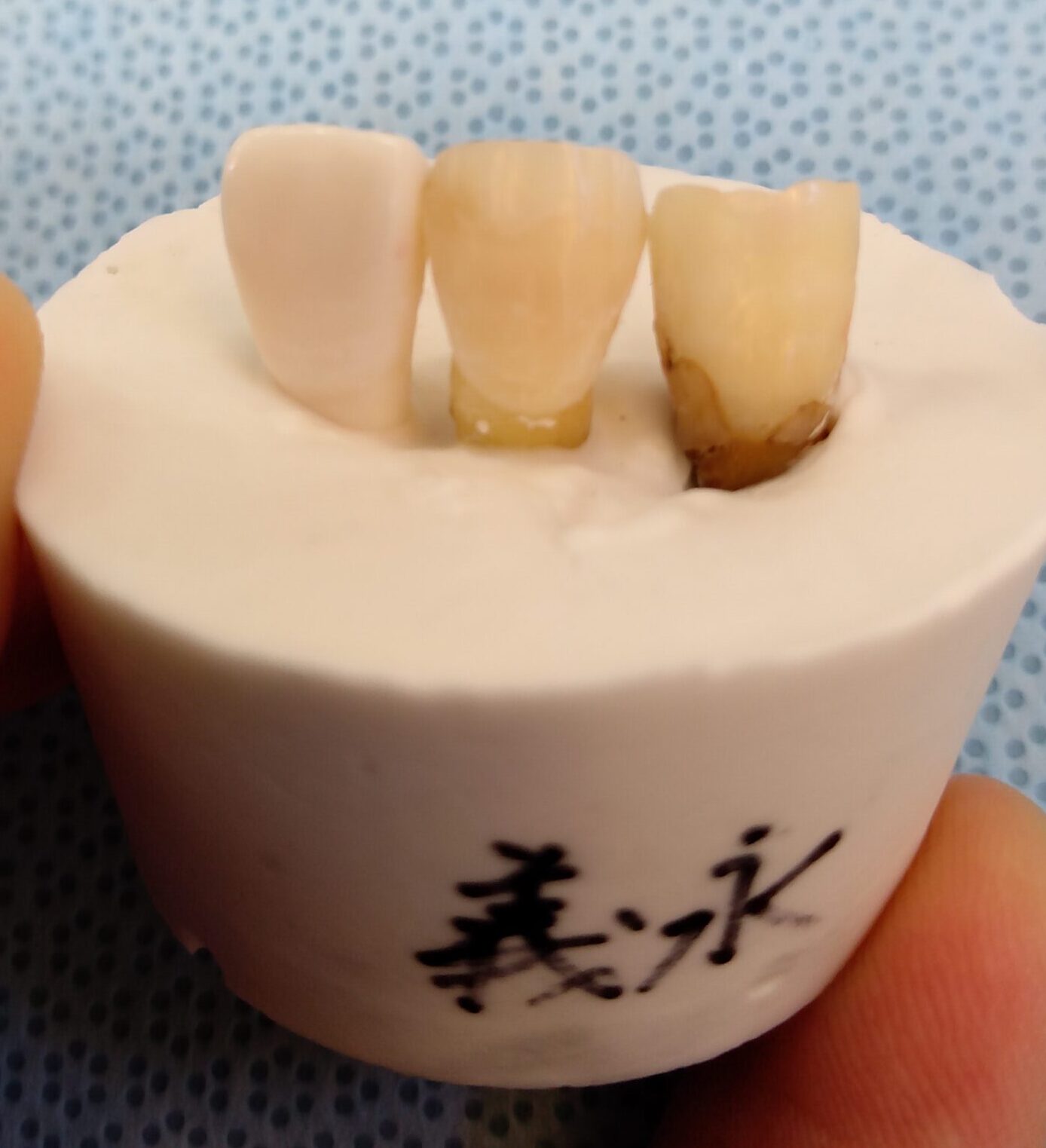 外傷の実習で行った破折の修復