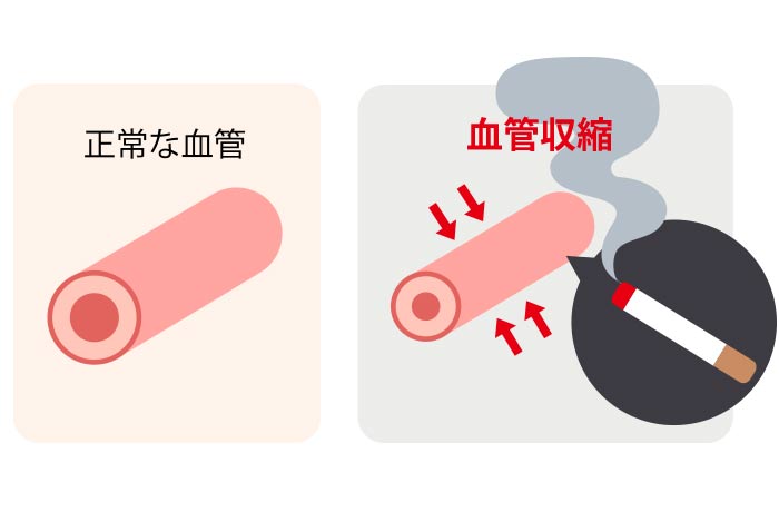 喫煙と⻭周病
