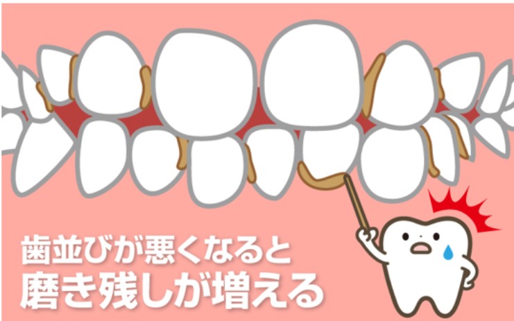 🦷歯並びが悪くなるとむし歯リスクも上がる!?