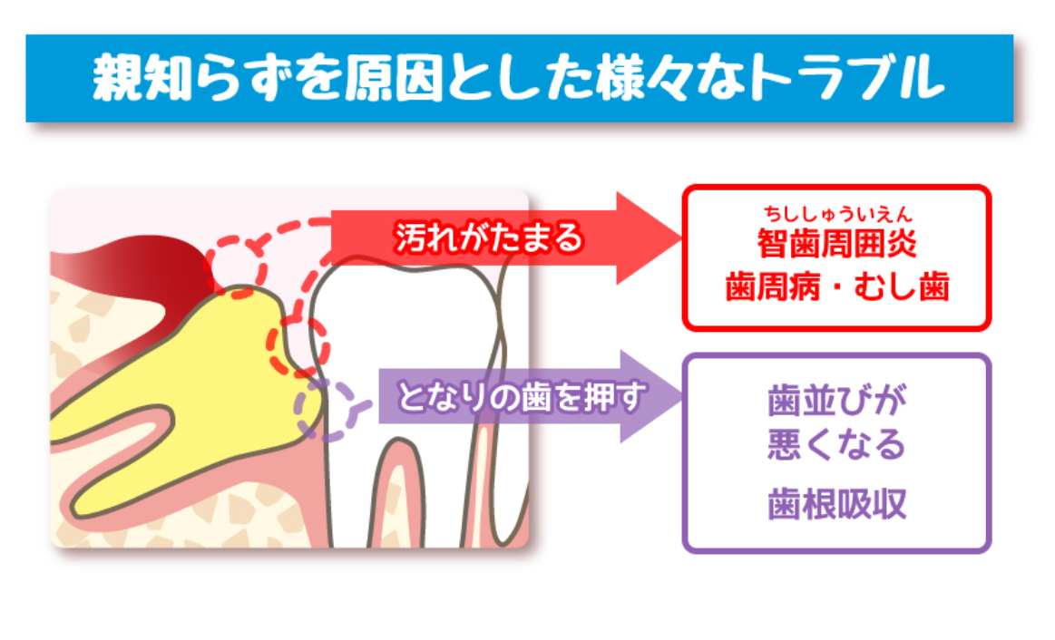 親知らず03