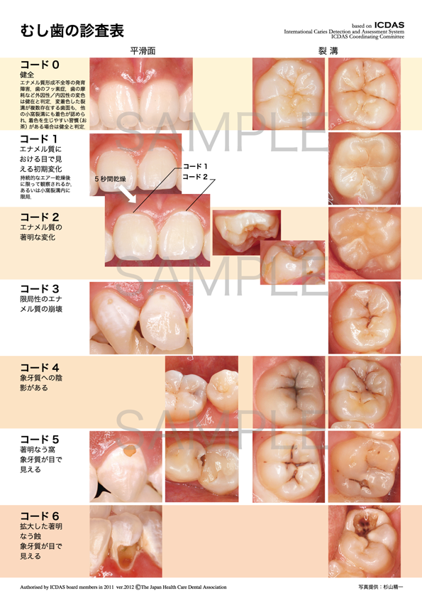 むし歯の分類 ICDAS（コード0〜6）