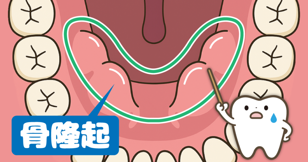 歯ぐきにできる硬いコブ「骨隆起」とは?