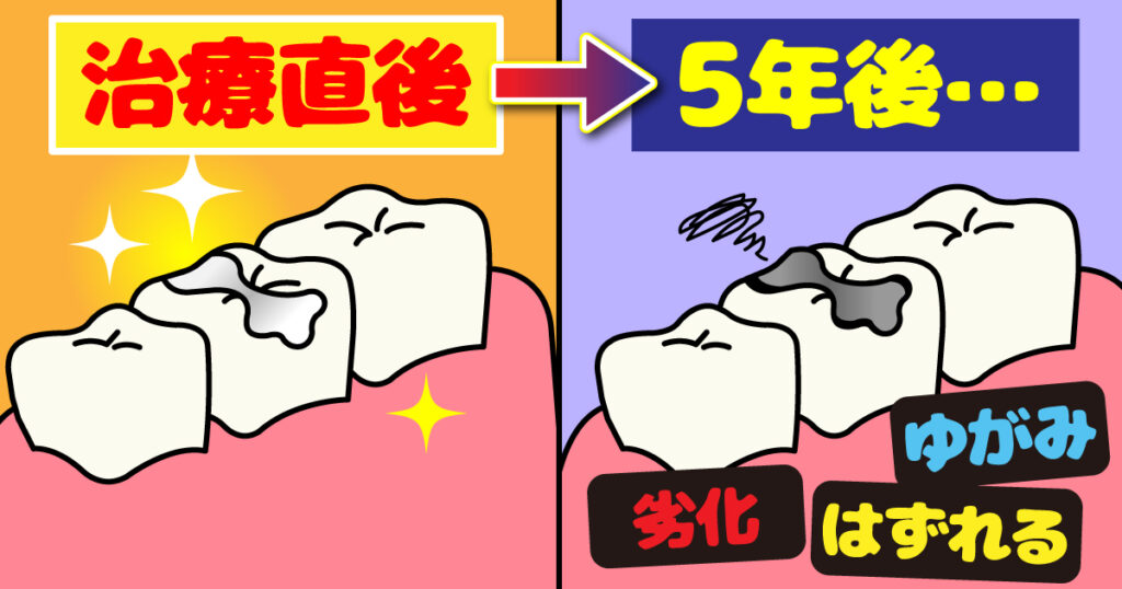 お口崩壊のはじまりは「小さなむし歯」から