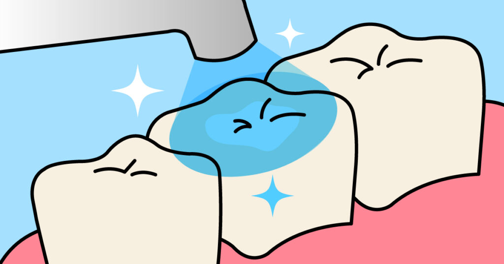 ◆白くて自然! CR(コンポジットレジン)とは