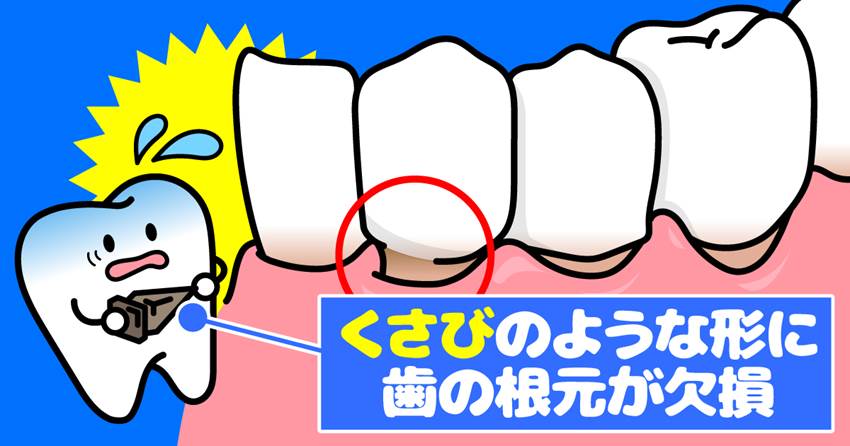 ◆これってむし歯?歯がしみるのは「くさび状欠損」かも!