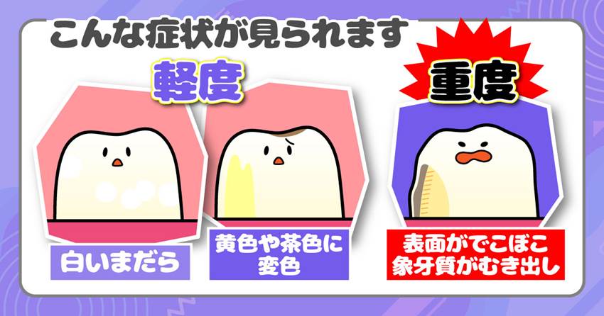 ◆そんなエナメル質が「もろく」なる?