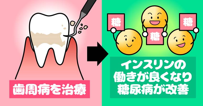 ◆歯周病を治療すると血糖値が改善することが明らかに!
