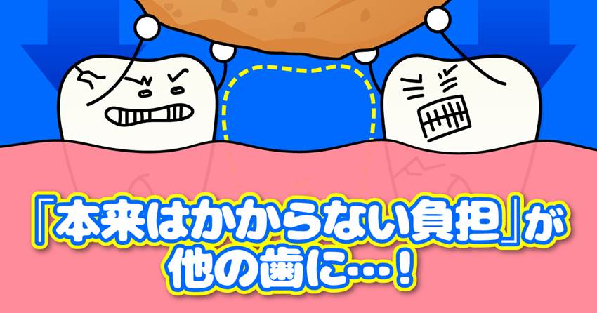 １本の歯が引き起こすお口の崩壊ドミノ