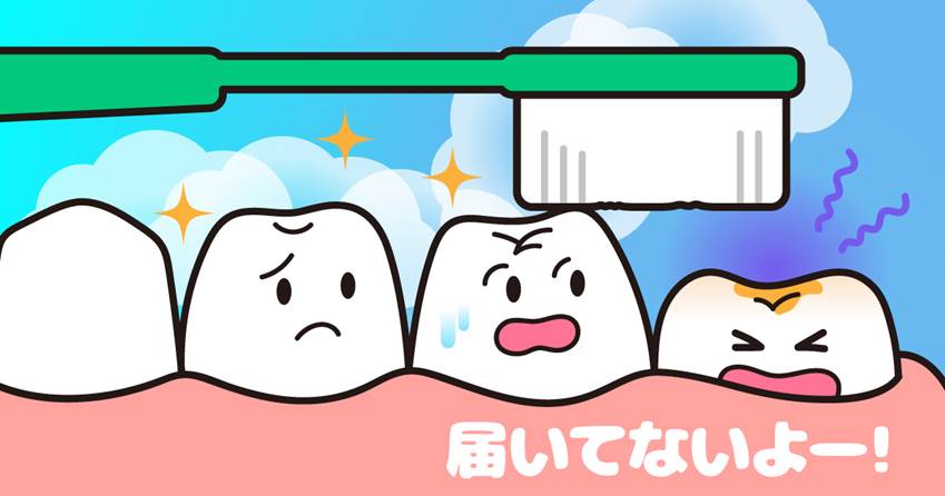 ◆6歳臼歯の弱点はむし歯!?