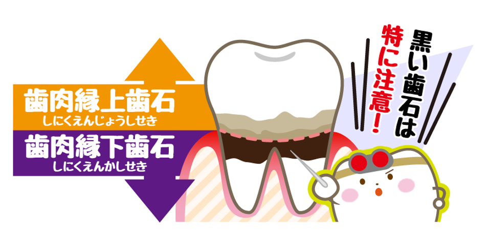 ♡「白い歯石」 と 「黒い歯石」