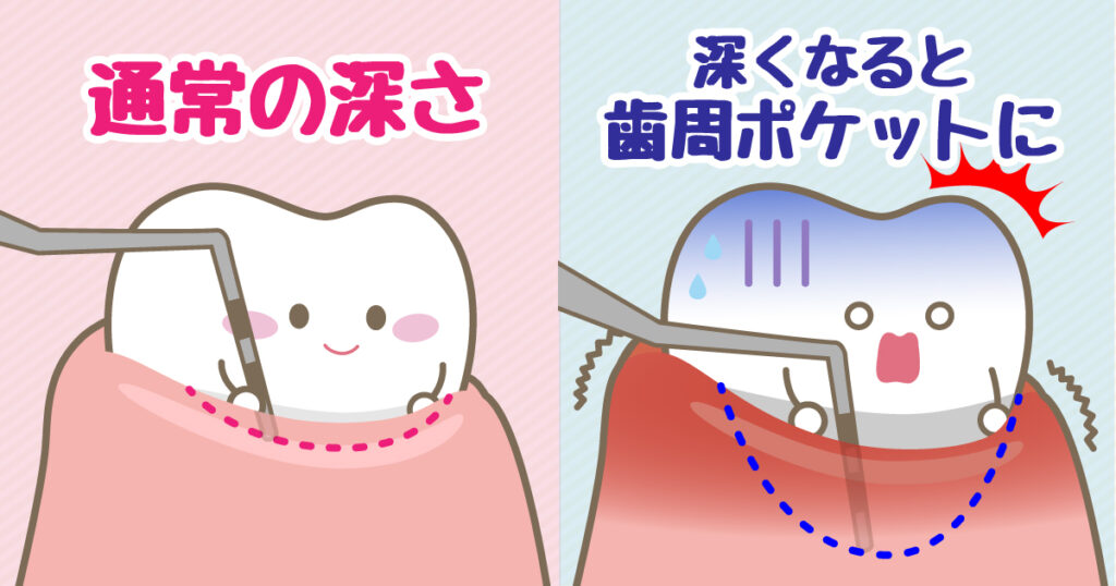 ◆『歯周ポケット』って一体なに？