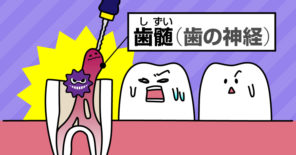 ◆むし歯が 神経まで 達すると…
