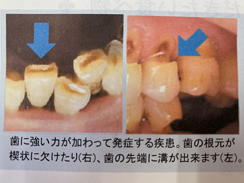 食いしばりにはコレ！　周智郡森町